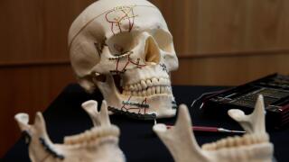 A skull with titanium plates of Medartis, a Swiss producer of metal implants for the surgical management of fractures, is seen during a news conference to present the planned IPO, in Zurich, Switzerland March 12, 2018. REUTERS/Moritz Hager