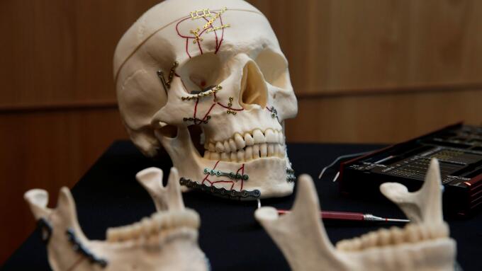 A skull with titanium plates of Medartis, a Swiss producer of metal implants for the surgical management of fractures, is seen during a news conference to present the planned IPO, in Zurich, Switzerland March 12, 2018. REUTERS/Moritz Hager